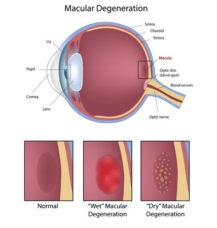 Wet/Dry Macular Degeneration
