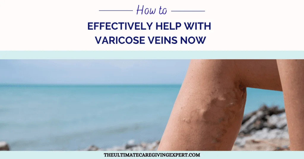 How To Effectively Help With Varicose Veins Now